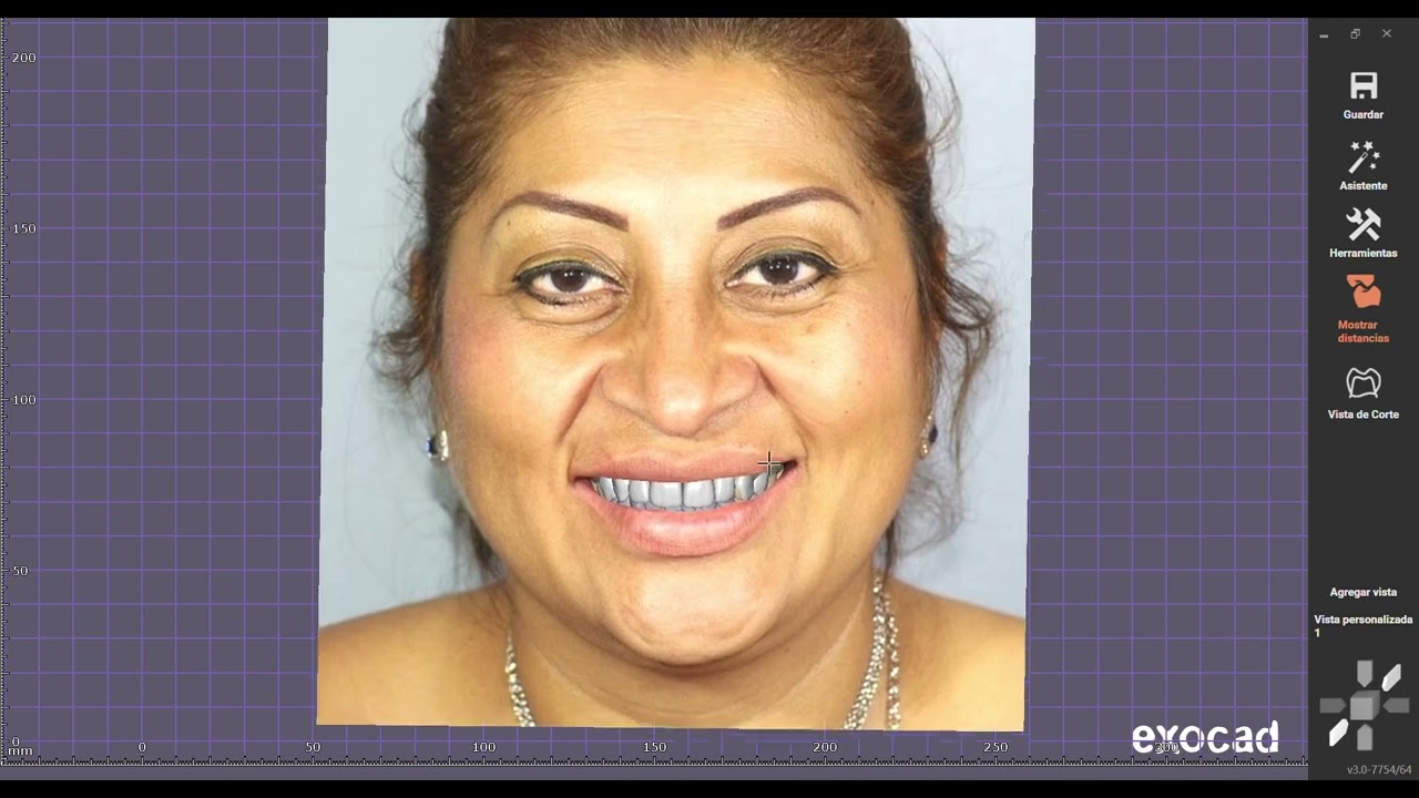 Matching Digital Dental Crowns with patient photo on Exocad