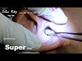 Superhuman Earwax - Người Siêu Ráy Tai Qúa Đã