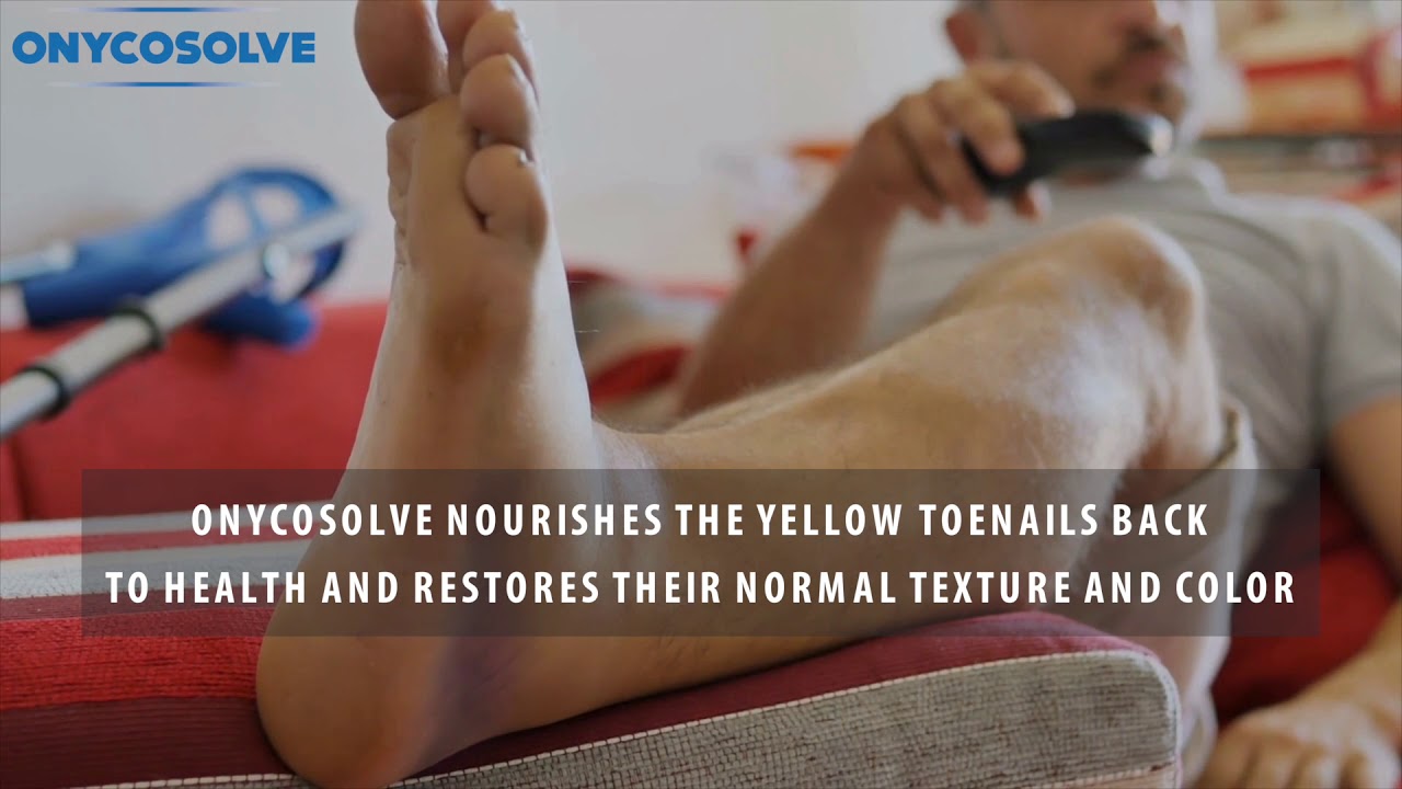 OnycoSolve - Get Rid of Feet Fungus In One Go - YouTube