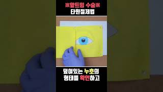 ※앞트임 수술 : 첫 번째. 타원절제법※