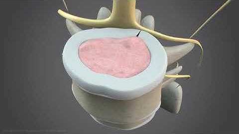 How nonsurgical spinal decompression works