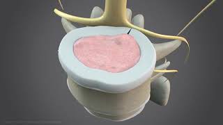 How nonsurgical spinal decompression works Profile
