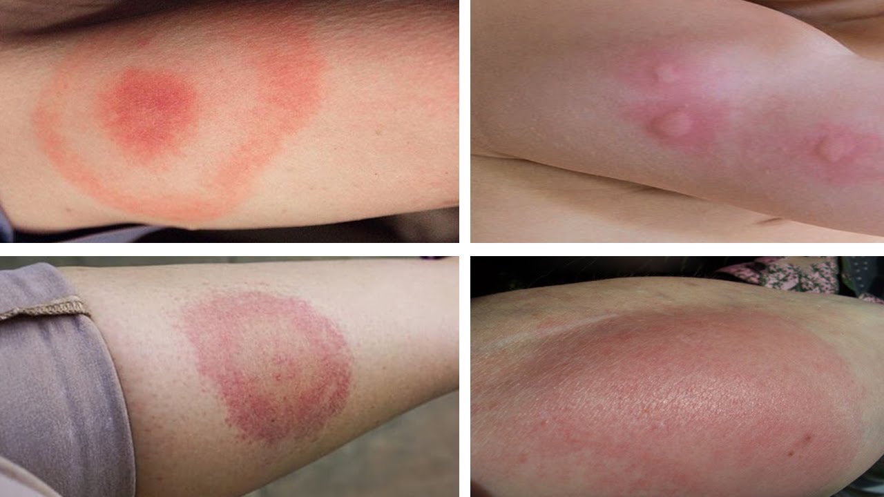 how-to-get-rid-of-mosquito-bites-overnight-youtube