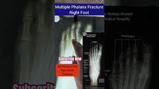 Foot X-Ray Anatomy & Multiple Phalanx Fracture Explained | Medical Simplify |Dr.Nafees Ahmad