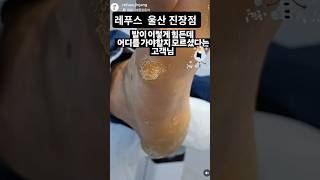 #내성발톱 #IngrownToenail #ToenailCare #FootCare #NailCare #FootHealth #巻き爪 #陥入爪 #MongQuap #ChamSocChan