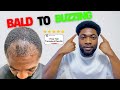 Hair Transplant in Turkey 1 Year Results (My SHOCKING Transformation) 👀🔥