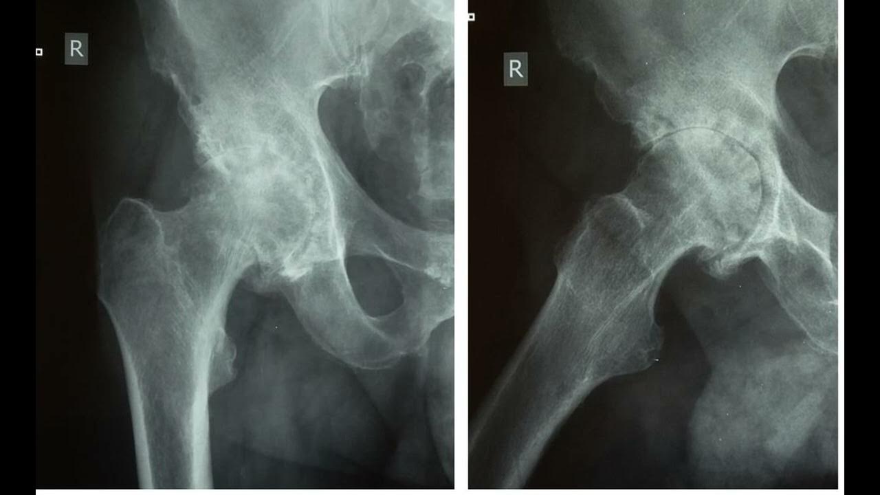 Некроз шейки бедра. Асептический некроз тазобедренного сустава рентген. ТБС рентген асептический некроз. Асептический некроз тазобедренного кости. Идиопатический асептический некроз тазобедренного сустава.