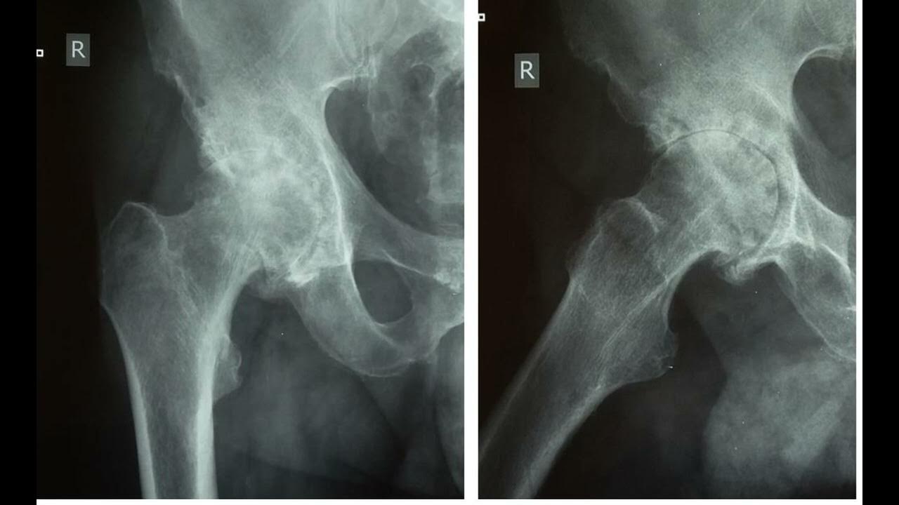 Операция тазобедренного сустава 1 степени. Асептический некроз тазобедренного сустава рентген. ТБС рентген асептический некроз. Асептический некроз тазобедренного кости. Идиопатический асептический некроз тазобедренного сустава.