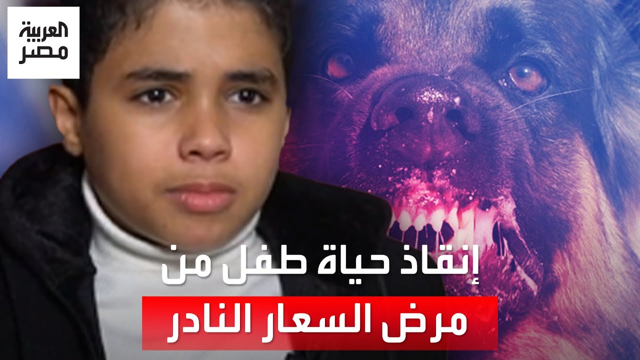 في إنجاز يعد الأول من نوعه عالميًا.. شفاء طفل مصاب بالسعار بسبب عضة كلب
