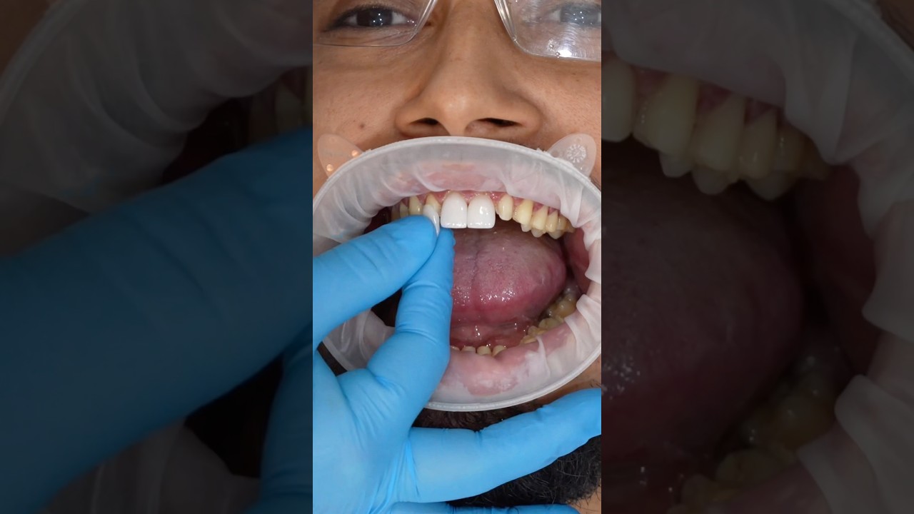 The Art of the Perfect Fit 💎 #veneers