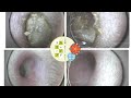 【耳そうじ】Vol. 38 自分で耳掃除しない場合の詰まり方 earcleaning & headmassage