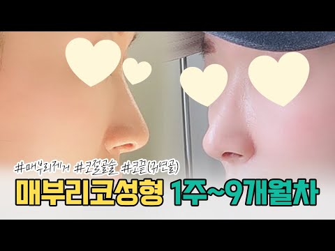 대만족👍 무보형물로 매부리코성형했어요! 매부리코+처진코끝 AFTER 9개월 후기 | 미고성형외과 Migo Plastic Surgery Rhinoplasty Review