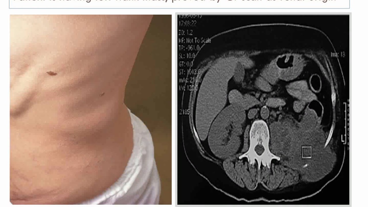 presentation of an abdominal mass