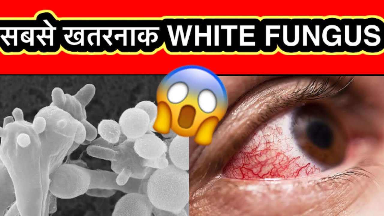 white fungus white fungus kya hai white fungus ke lakshan white