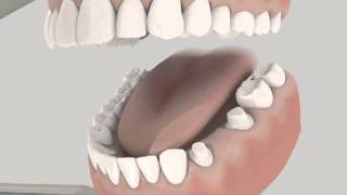 Dental Bridge animation