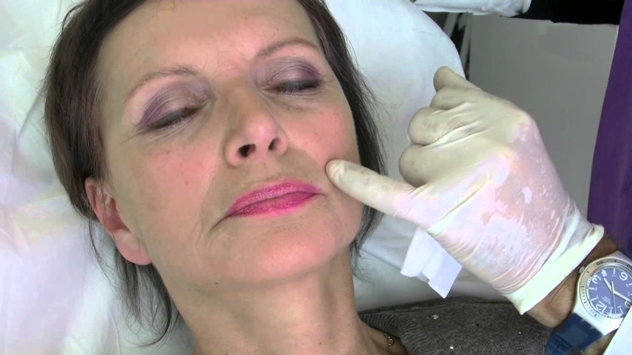 Olga : Global French Touch - Rajeunissement du visage Dr Philippe BELLITY