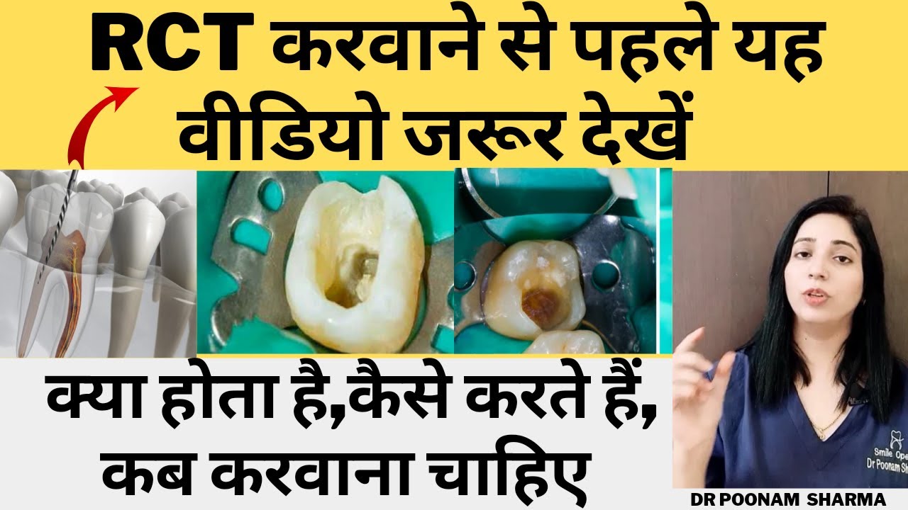 Root Canal Treatment (RCT)क्या होता है, कब करना जरुरी है,Root Canal