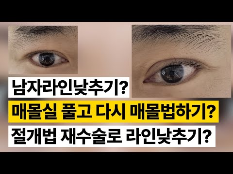 성형상담소 💌 I 매몰법 후 부담스러운 남자 쌍꺼풀, 라인 낮출 수 있을까요?