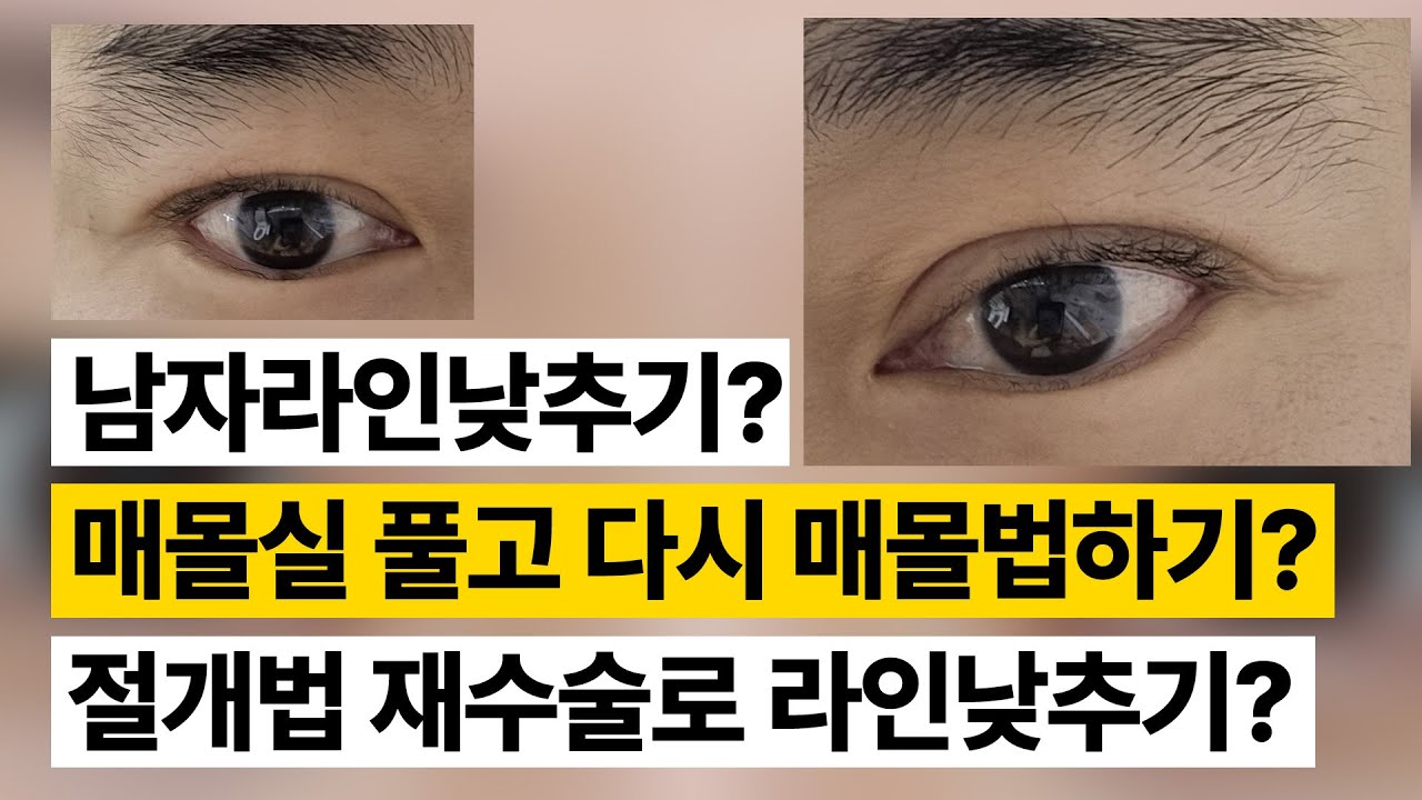 [Ганнам Соёон гоо сайхны мэс засал] Гоо сайхны зөвлөгөө 💌 I Оёдолгүй аргаар хийсэн давхрагын дараа эрэгтэй хүнд хэтэрхий тод харагдах давхрагын шугамыг багасгах боломжтой юу?