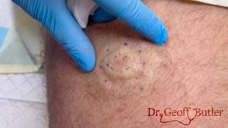 Removal of an epidermal cyst on the leg