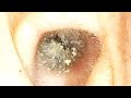 【耳掃除】#125 〜奥の獲物GET!粘着綿棒出番です〜 earwax