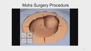 Mohs Micrographic Technique -  An Overview screenshot 1