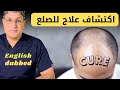 هل انتهى زمن زراعة الشعر    خبراء يكشفون عن علاج ثوري للصلع يعيد نمو الشعر سمعها