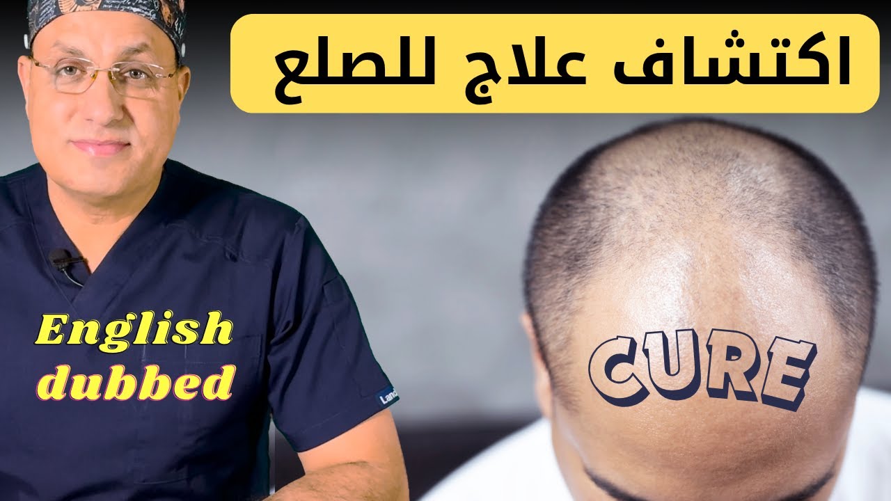 هل انتهى زمن زراعة الشعر؟ 🤯 خبراء يكشفون عن علاج ثوري للصلع يعيد نمو الشعر