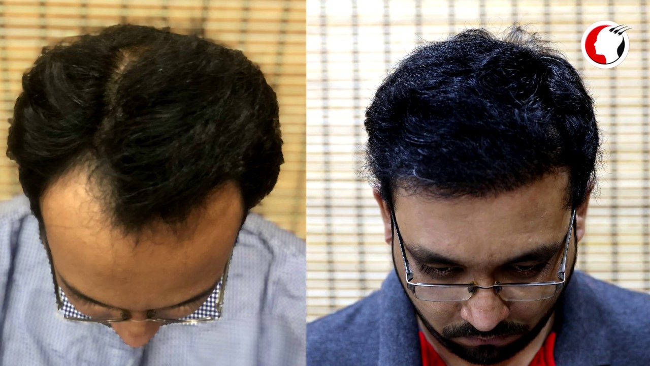 Best FUE Hair Transplant Result New Roots Hair Clinic hairtransplant Best FUE Hair Transplant Result New Roots Hair Clinic hairtransplant