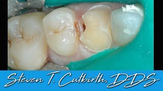 Interproximal Composites Adjacent To Crown Prep - Dental Minute With Steven T. Cutbirth, Dds