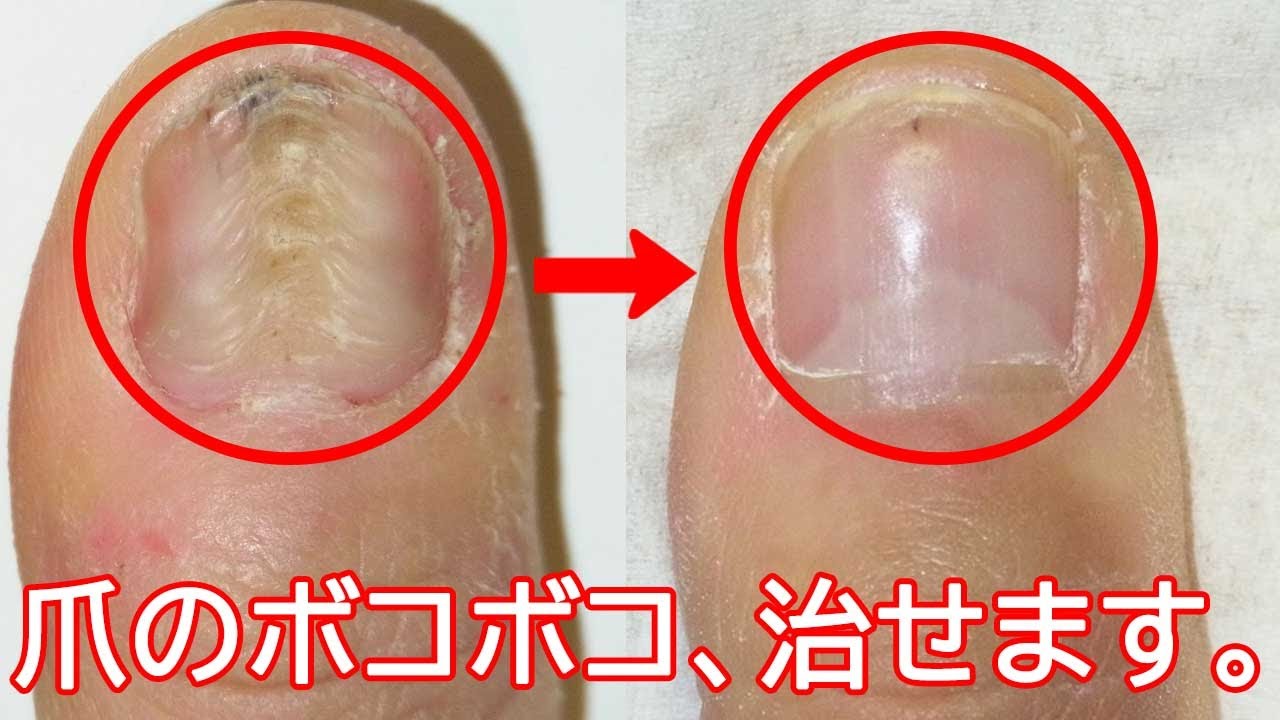 左親指爪割 左親指爪