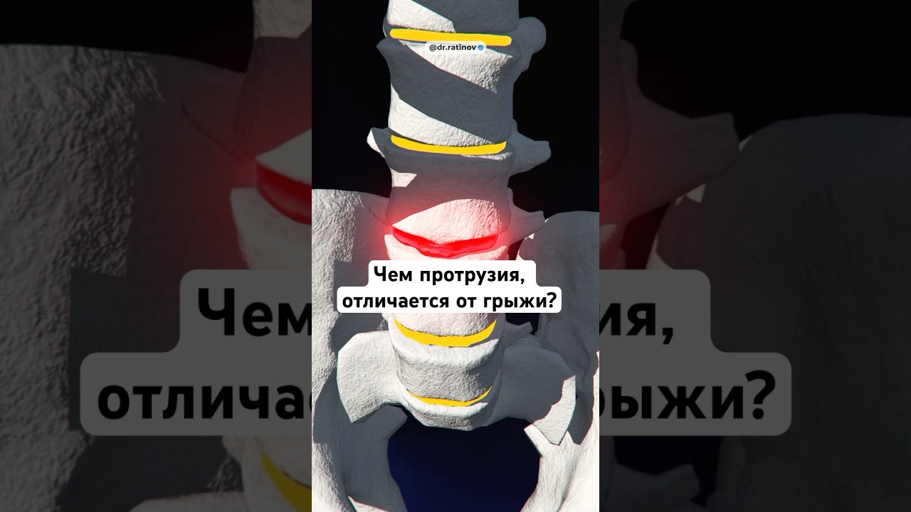 Протрузия и грыжа, вот в чем разница #грыжапозвоночника #протрузия #больвспине #остеохондроз