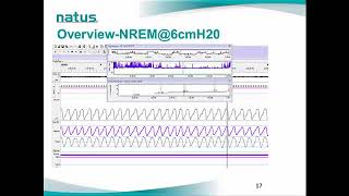 Natus PSG Webinar: What are you missing from your PSG recordings?
