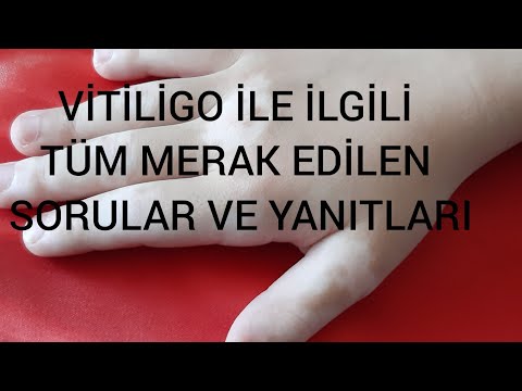 Vitiligo İçin Doktorumuz Hangi Tedaviyi Uyguladı? Sonuç Ne Oldu? Doğal Yöntemler İşe Yarıyor mu?