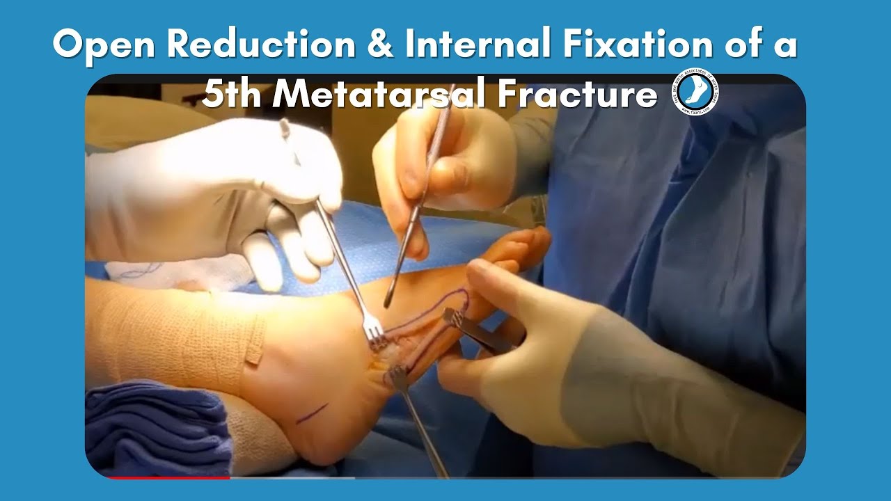 Open Reduction And Internal Fixation Of A 5th Metatarsal Fracture Youtube