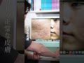 ニキビ跡モニター密着▶Part１