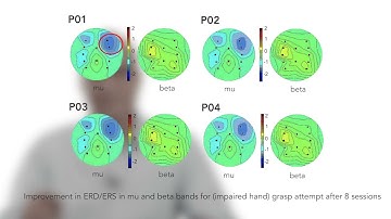 Brain Computer Interface (BCI) based hand exoskeleton for neuro-rehabilitation of stroke patients