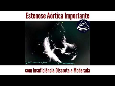 Vídeo: Indo Além Do Eco Clássico Na Estenose Aórtica: Mecânica Do átrio Esquerdo, Um Novo Marcador De Gravidade