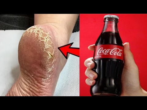 Get rid of cracked heels and get the smooth white feet home remedy