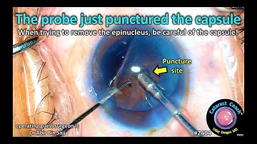 CataractCoach™ 2404: the probe just punctured the posterior capsule during epin-ucleus removal