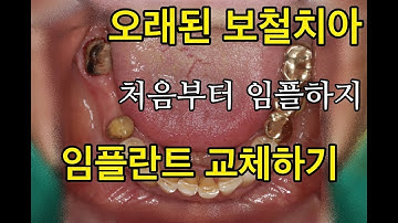 금니 브리지 포세린 보철로 교체하기. 브리지 위험성