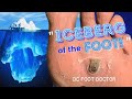 Iceberg of the Foot: Removing Painful Pororkeratosis