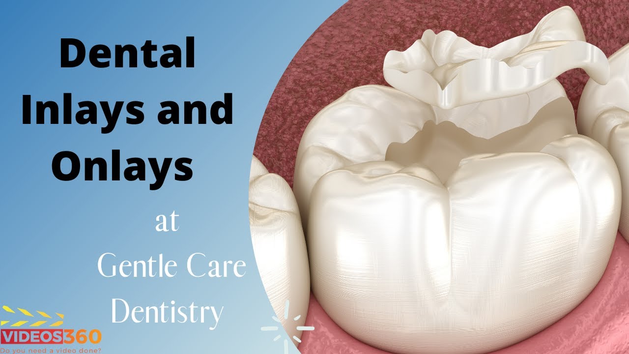 Dental Inlays and Onlays explained by Dr. Brianne Luu - YouTube
