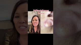 Dr Pimple Popper Reacts to Oddly Shaped Ear Cyst #dermatology