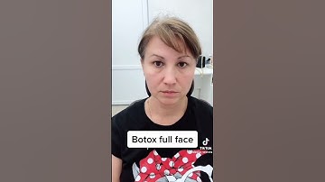 Các điểm tiêm botox fullface #orchard #botox #shorts