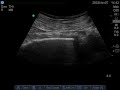 parasacral sciatic nerve block - casal&#39;s approach -screening