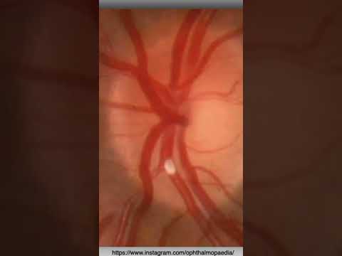 Émbolo intravascular retiniano. #embolia #embolo #retina #oftalmologia #optometria