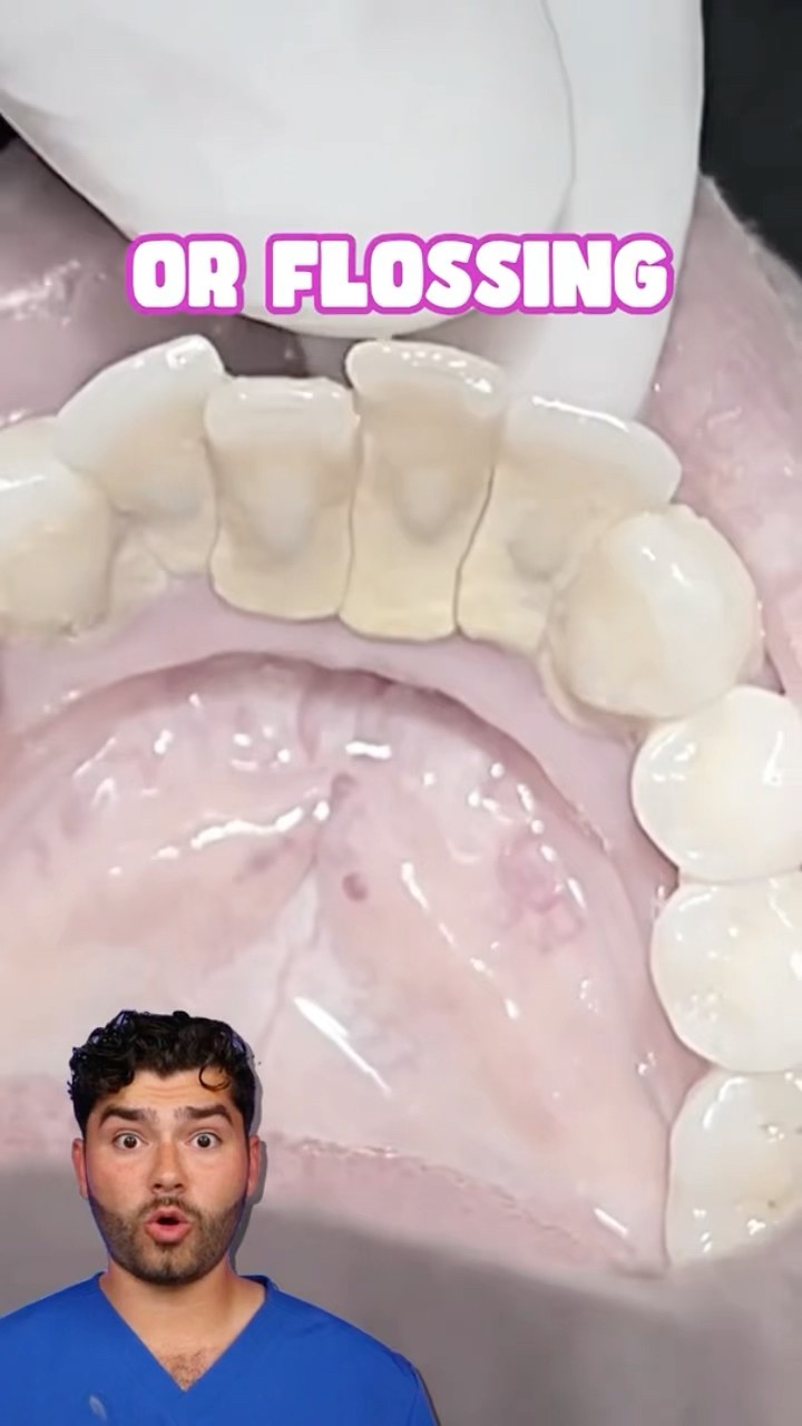 Teeth Cleaning Explained !?