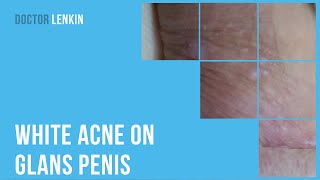 White Acne On Glans Penis