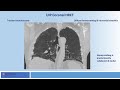 Clinical Cases in Interstitial Lung Disease - Case 2